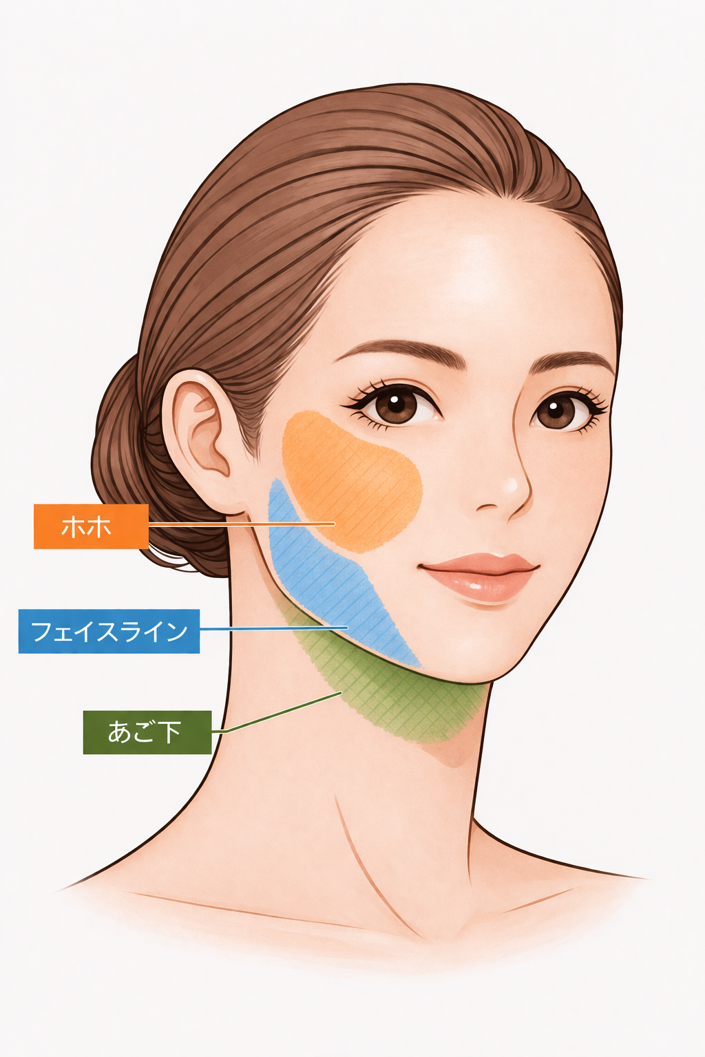 糸リフトショート（ショートスレッド）とは？